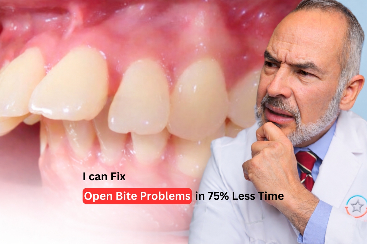Braces for Open Bite: A Modern Smile Solution