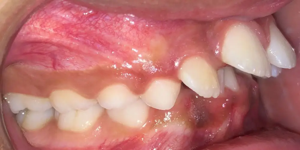 img-Early-or-Interceptive-Treatment-pic-1