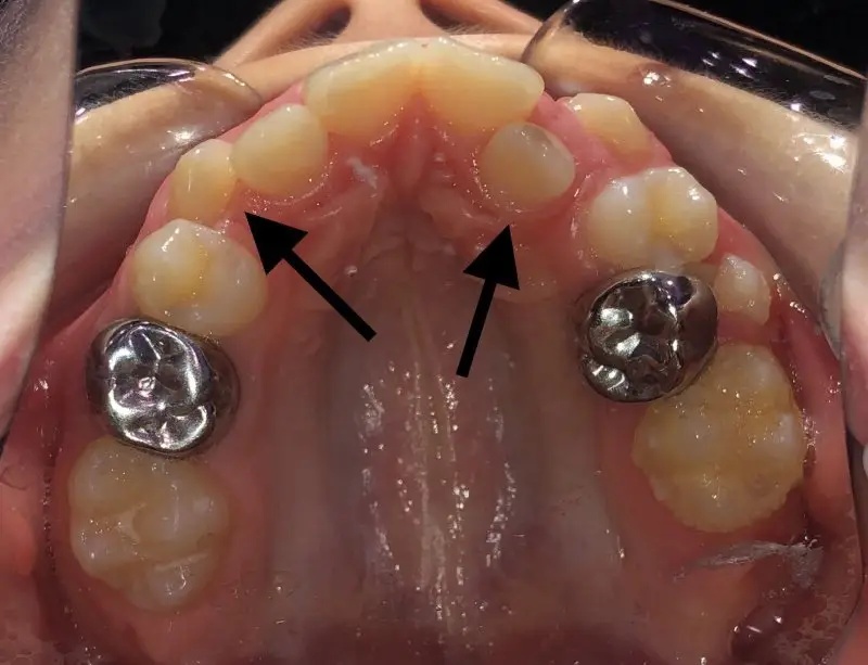 img-Early-or-Interceptive-Treatment-pic-10