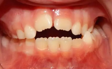 img-Early-or-Interceptive-Treatment-pic-2