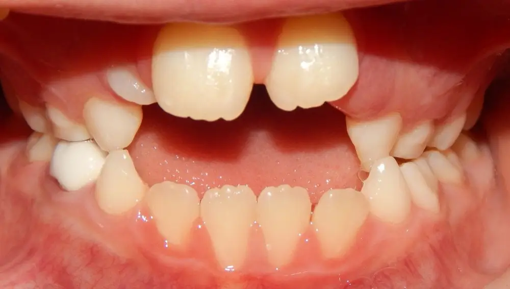 img-Early-or-Interceptive-Treatment-pic-3