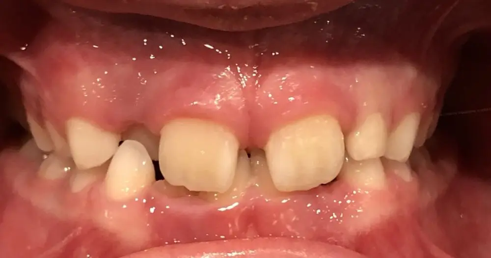 img-Early-or-Interceptive-Treatment-pic-6