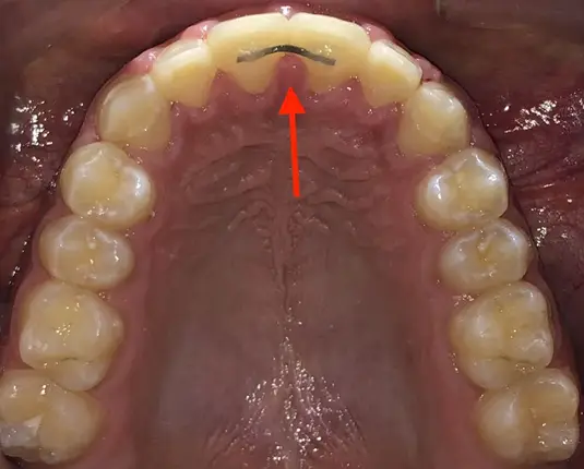img Fixed Retainers (Bonded Retainers) 1
