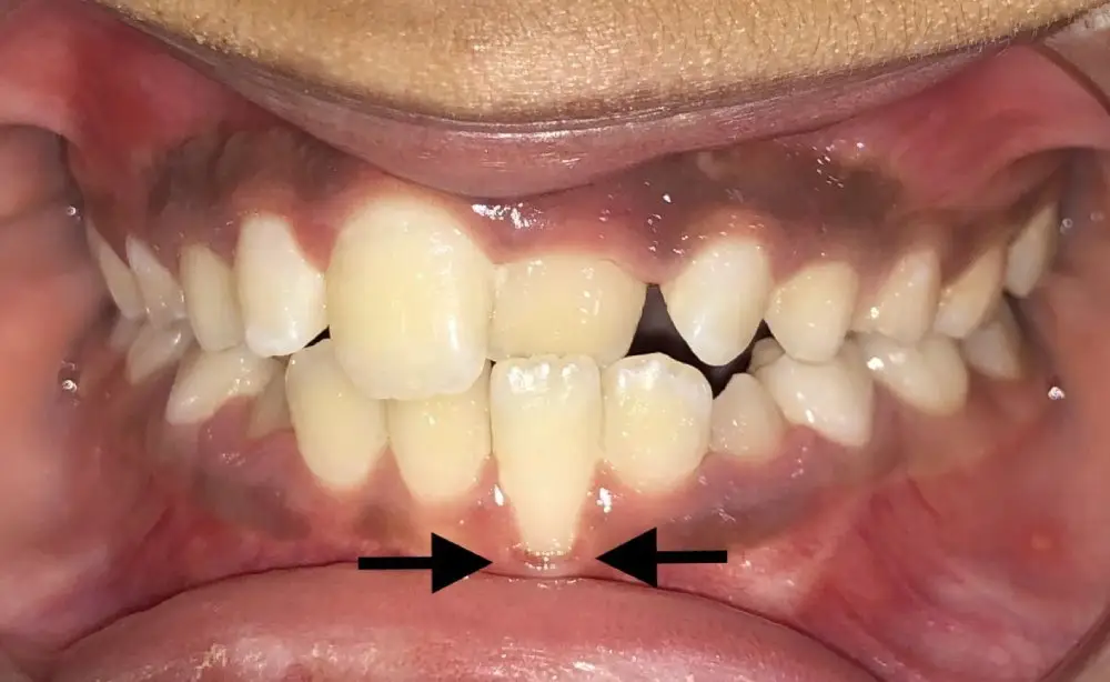 img-Premature-Gum-Recession