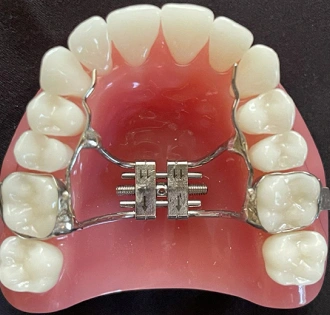img-braces-for-kids-Palatal Expanders 1
