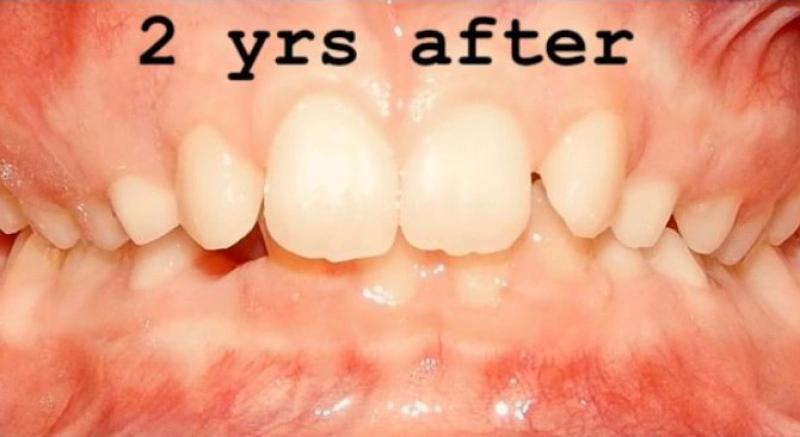 img-braces-for-kids-after 1