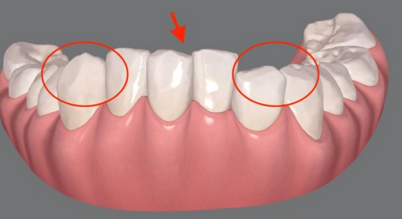 img-braces-for-kids-after 3