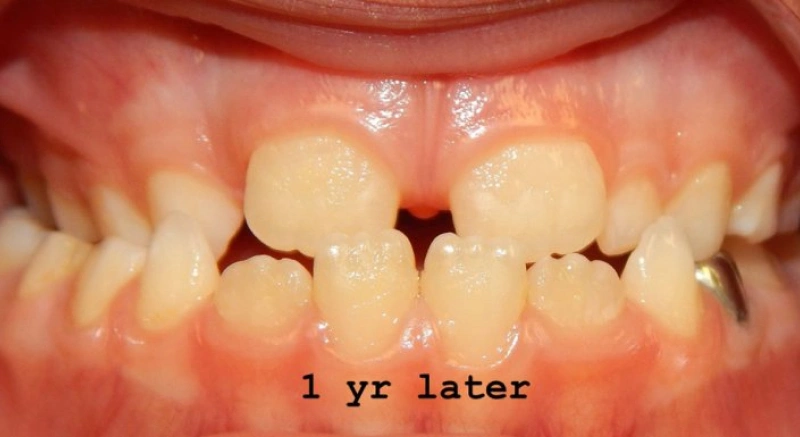 img-braces-for-kids-after 4