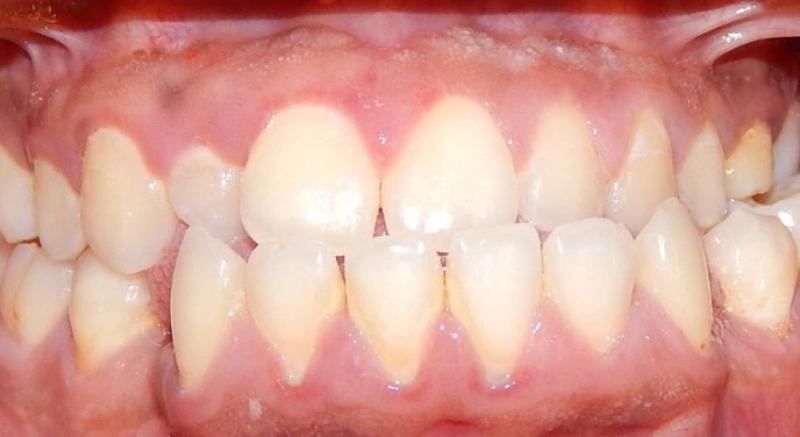 img-braces-for-kids-after 5