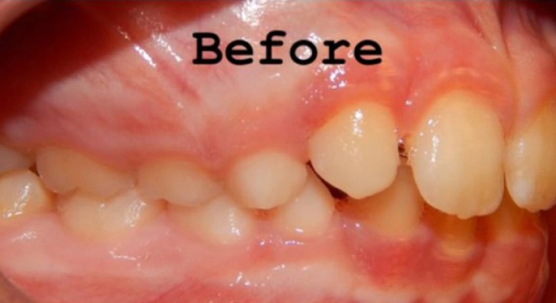 img-braces-for-kids-before 2