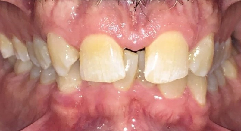 img-braces-for-kids-before 3
