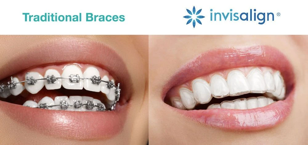 img-Advantages-Does-Invisalign