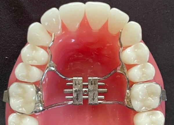 img-orthodontic-treatment-phases-Metal-expanders
