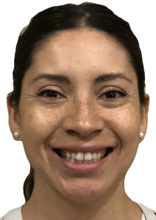 Adrianna - Adult comprehensive orthodontic treatment before