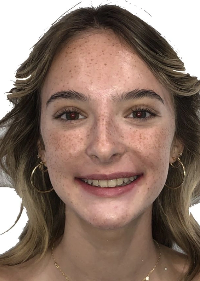 Avery - Teen omprehensive orthodontic treatment after