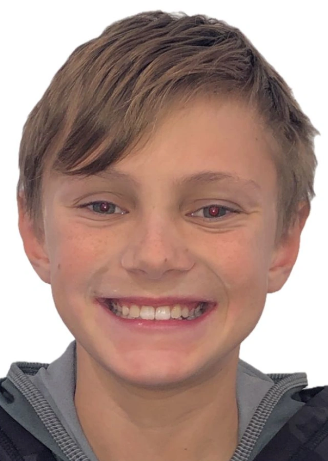 Casen - Early interceptive Phase I orthodontic treatment after