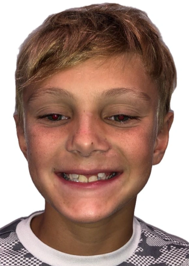 Casen - Early interceptive Phase I orthodontic treatment before
