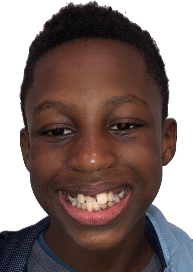 David - Teen omprehensive orthodontic treatment before