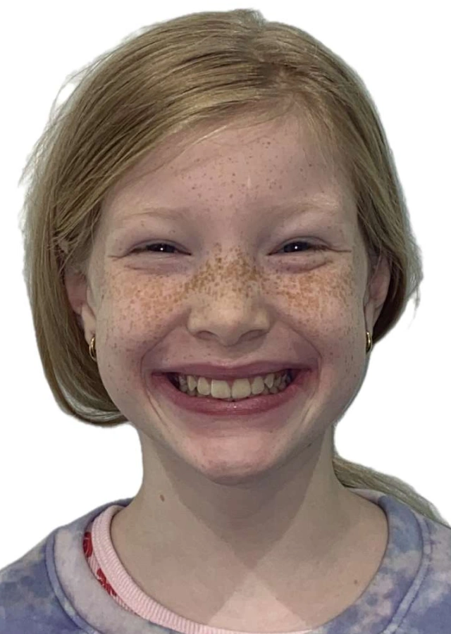 Ivy - Early interceptive Phase I orthodontic treatment after