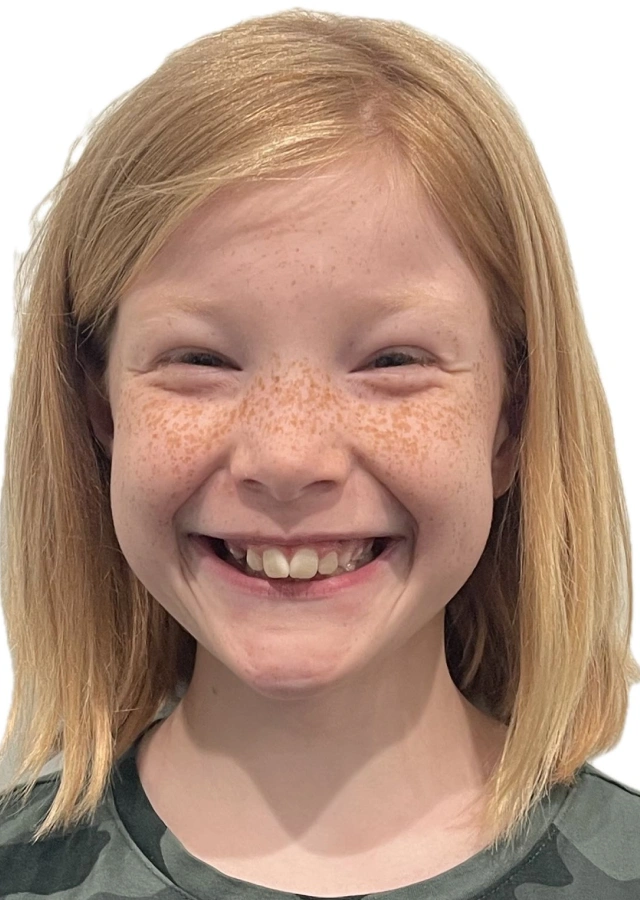 Ivy - Early interceptive Phase I orthodontic treatment before