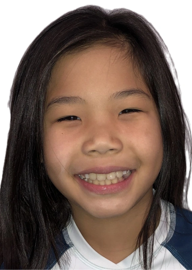 Jackie - Early interceptive Phase I orthodontic treatment after