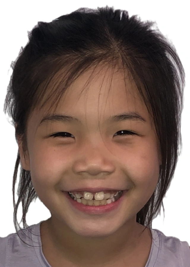 Jackie - Early interceptive Phase I orthodontic treatment before