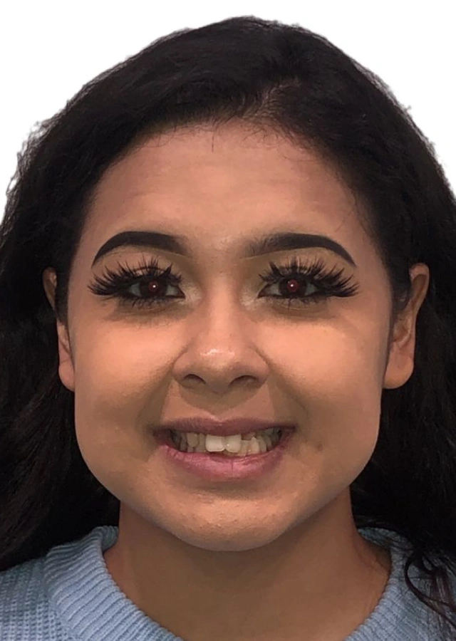 Jazmin - Adult comprehensive orthodontic treatment before